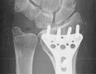 橈骨遠位端骨折の治療について 広島医療生活協同組合 広島共立病院