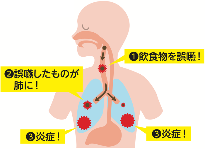 誤嚥性肺炎予防について 広島医療生活協同組合 広島共立病院