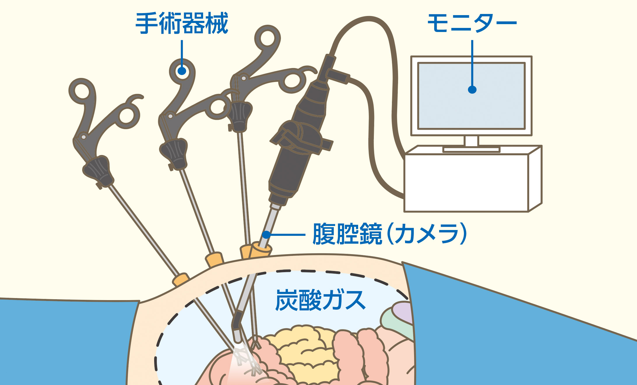 腹腔鏡手術とは？ - 広島医療生活協同組合 広島共立病院